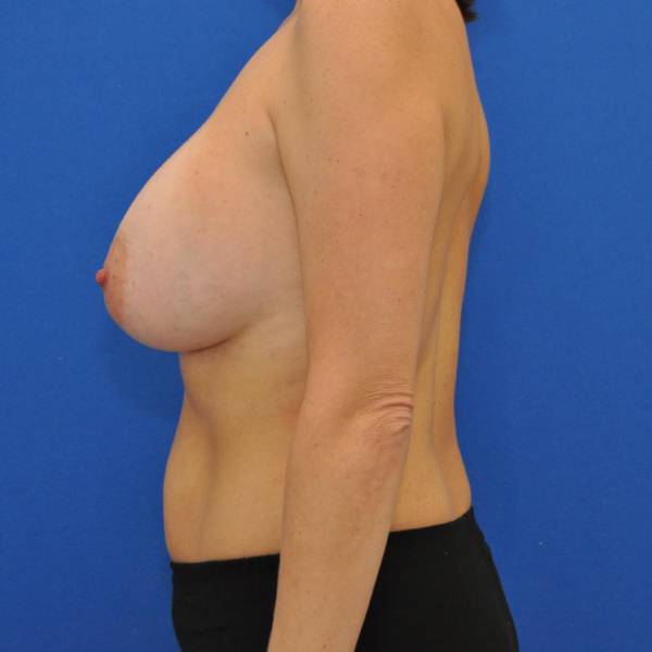 after Breast Augmentation side view Case 1457