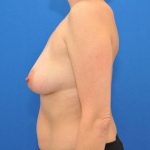 before Breast Augmentation side view Case 1457