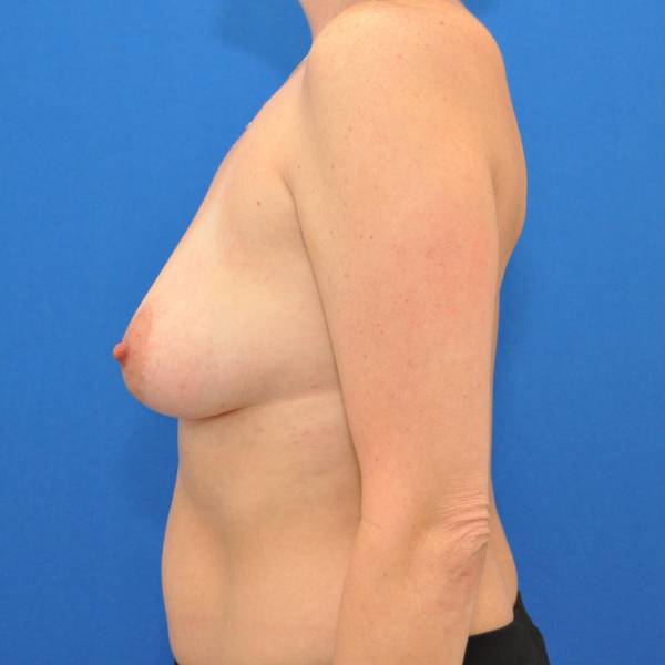 before Breast Augmentation side view Case 1457