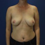 before breast augmentation front view female case 1471