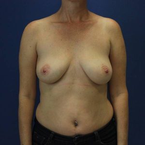 before breast augmentation front view female case 1471