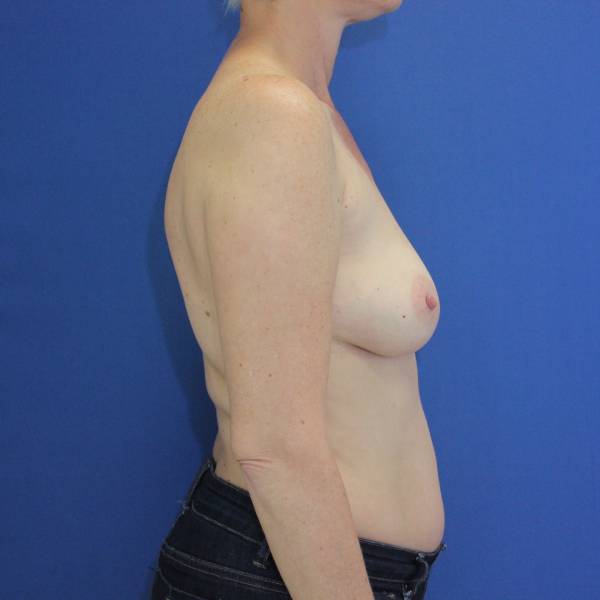 before breast augmentation right side view female case 1471
