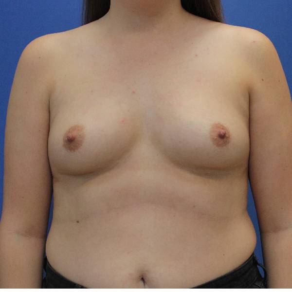 before breast augmentation front view female case 1492
