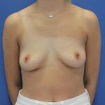 before Breast Augmentation front view female patient case 1436