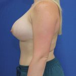 after breast augmentation with lift left side view case 1615