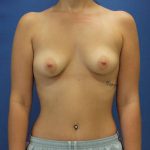 before breast augmentation with lift front view case 1637