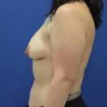 before breast augmentation with lift left side view case 1648