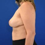 after breast reduction with lift left side view case 1510