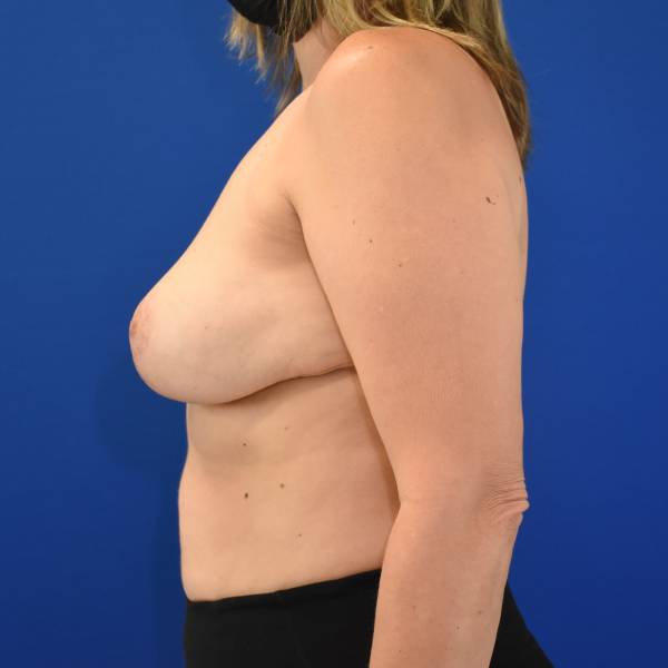 after breast reduction with lift left side view case 1510