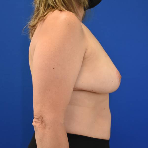 after breast reduction with lift right side view case 151
