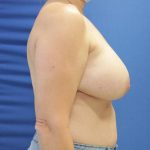 before breast reduction with lift right side view case 151