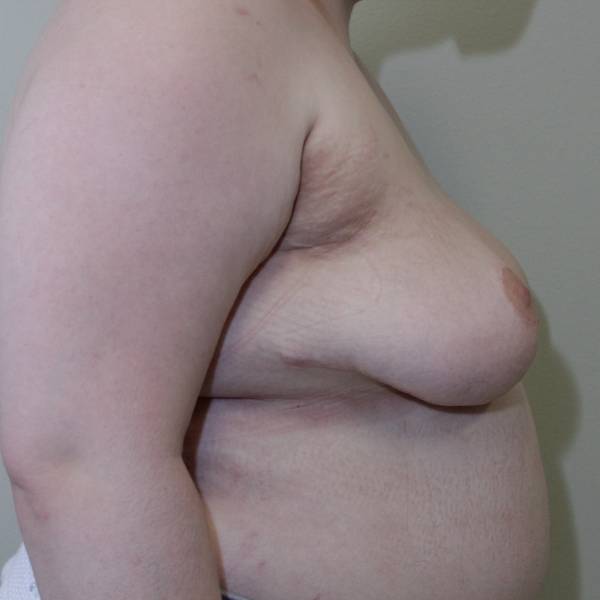after breast reduction with lift right side view case 1521