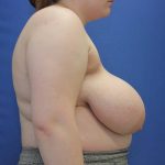 before breast reduction with lift right side view case 1521