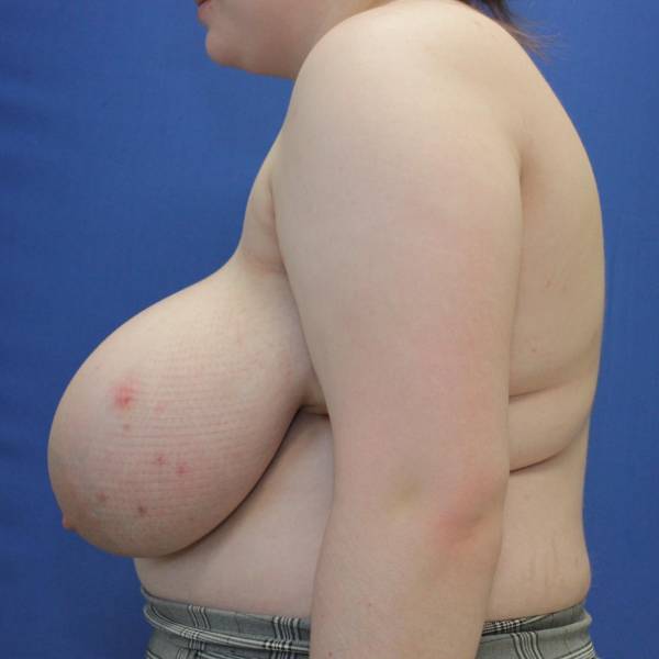 before breast reduction with lift left side view case 1521