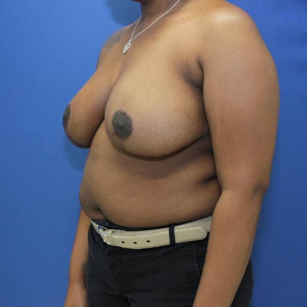 after breast reduction with lift left side view case 1532
