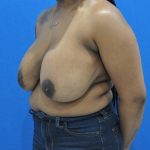 before breast reduction with lift left angle view case 1532