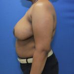 after breast reduction with lift left side view case 1532
