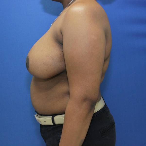 after breast reduction with lift left side view case 1532
