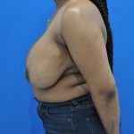 before breast reduction with lift left side view case 1532