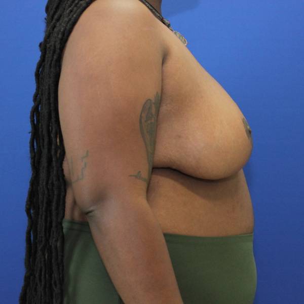 after breast reduction with lift right side view case 1543