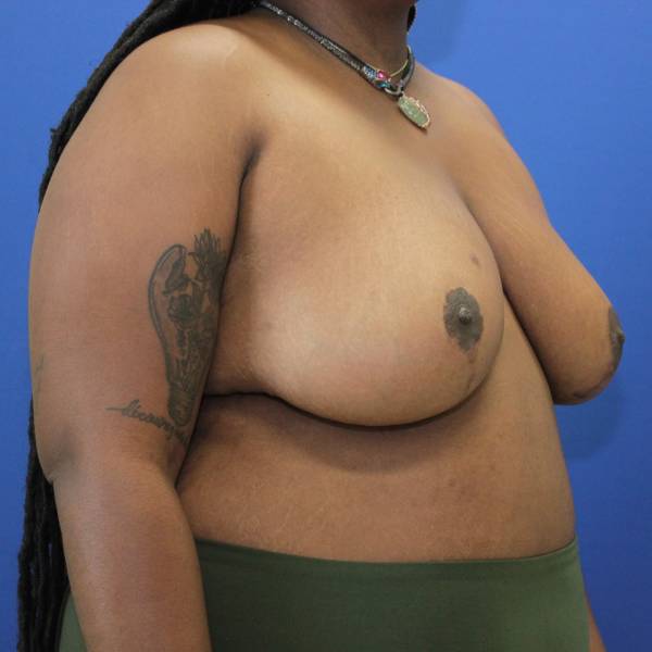 after breast reduction with lift right angle view case 1543