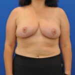 after breast reduction with lift front view case 1555