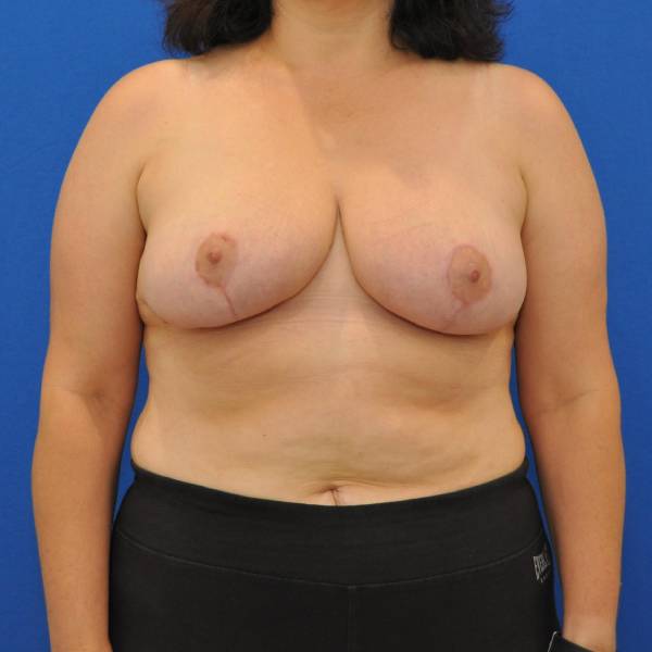 after breast reduction with lift front view case 1555
