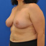 after breast reduction with lift left side view case 1555