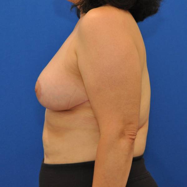 after breast reduction with lift left side view case 1555