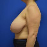 before breast reduction with lift left side view case 1555