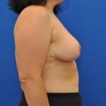 after breast reduction with lift right side view case 1555