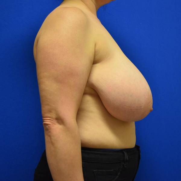 before breast reduction with lift right side view case 1555