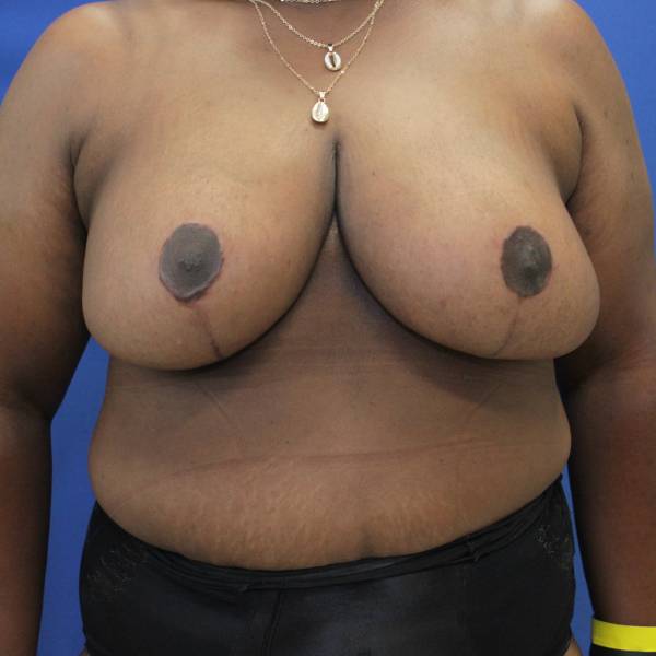 after breast reduction with lift front view case 1566