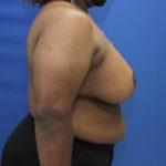 after breast reduction with lift right side view case 1566