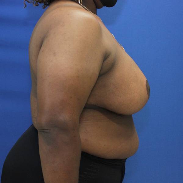 after breast reduction with lift right side view case 1566