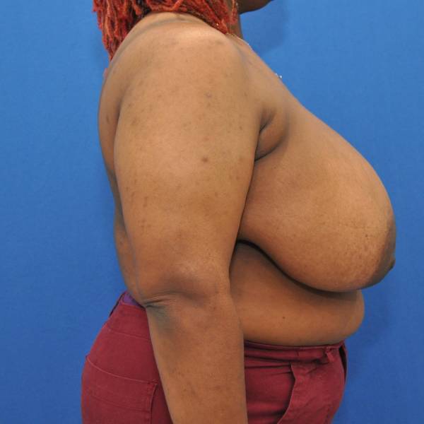 before breast reduction with lift right side view case 1566