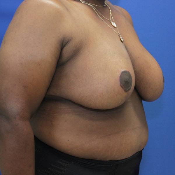before breast reduction with lift right angle view case 1566