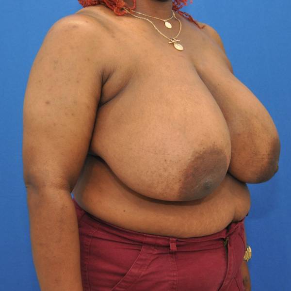 before breast reduction with lift right angle view case 1566