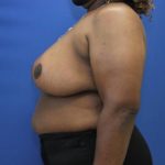 after breast reduction with lift left side view case 1566