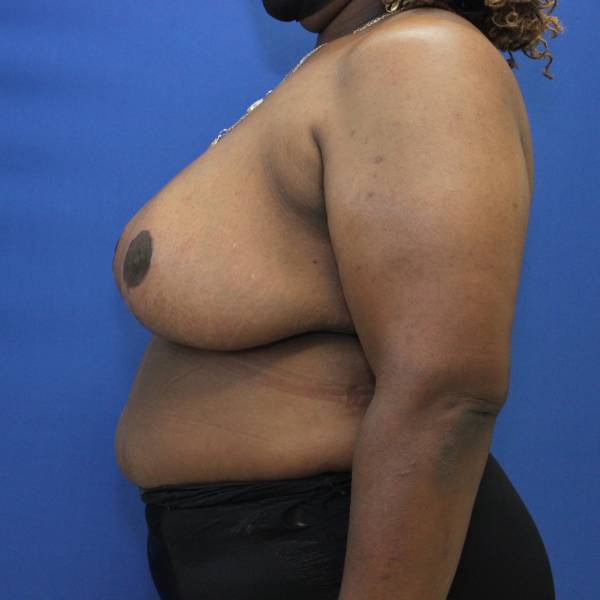 after breast reduction with lift left side view case 1566