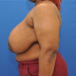 before breast reduction with lift left side view case 1566