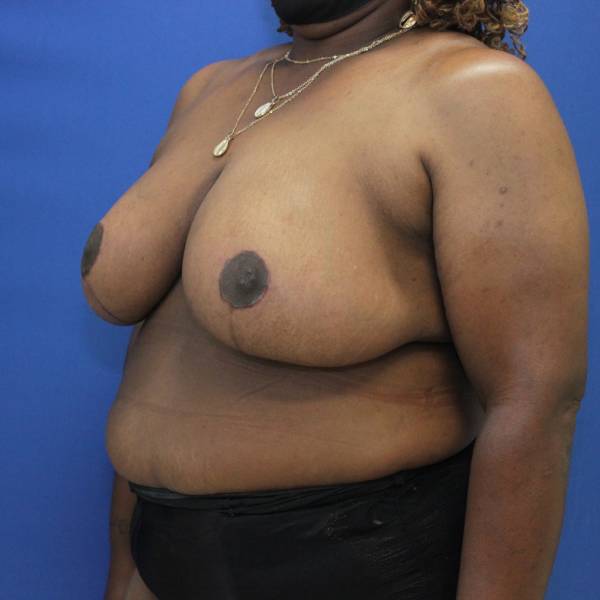 after breast reduction with lift left angle view case 1566
