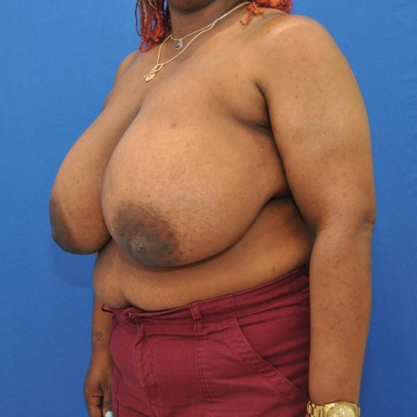 before breast reduction with lift left angle view case 1566