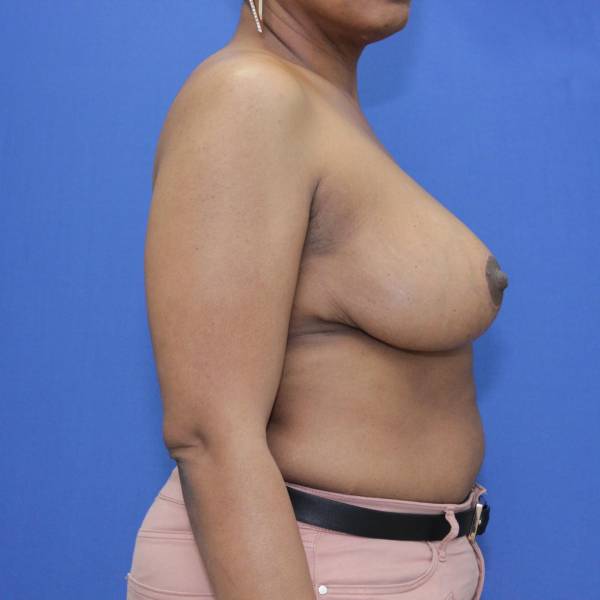 after breast reduction with lift right side view case 1577