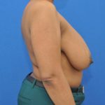 before breast reduction with lift right side view case 1577