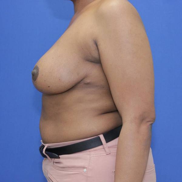 after breast reduction with lift left side view case 1577