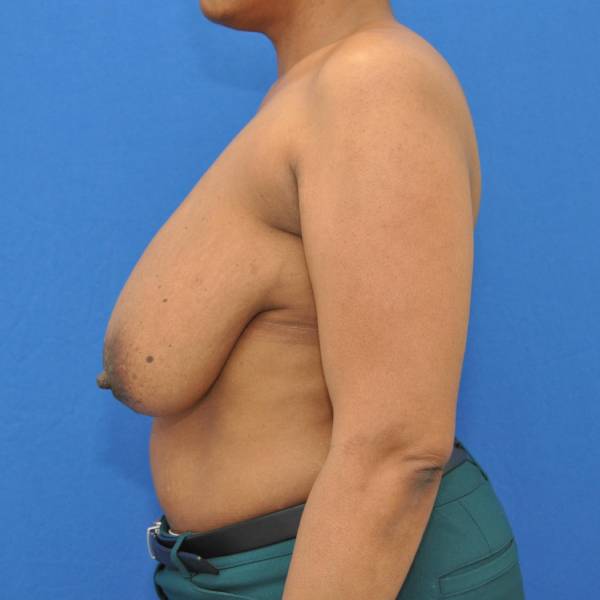 before breast reduction with lift left side view case 1577