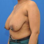 before breast reduction with lift left angle view case 1577