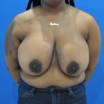 before breast reduction with breast lift front view case 1532