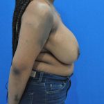 before breast reduction with breast lift right side view case 1532